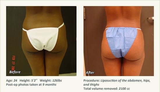 Liposuction Surgery in Dallas & Plano - Patient 28