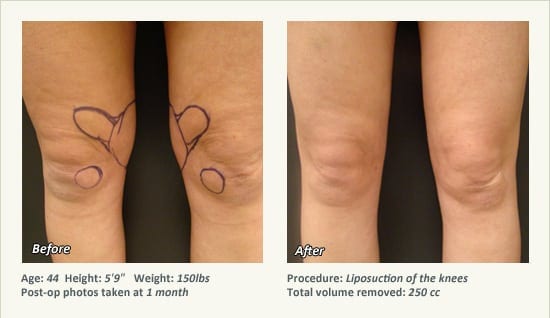 Liposuction Surgery in Dallas & Plano - Patient 29