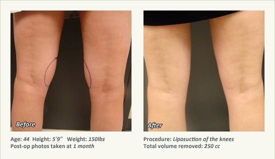 Liposuction Surgery in Dallas & Plano - Patient 30