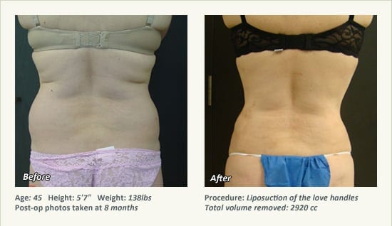 Liposuction Surgery in Dallas & Plano - Patient 31