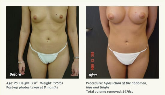 Liposuction Surgery in Dallas & Plano - Patient 32
