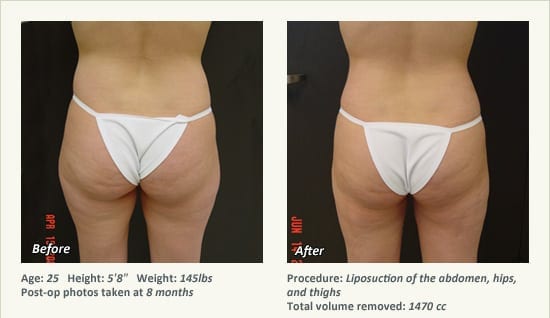 Liposuction Surgery in Dallas & Plano - Patient 33