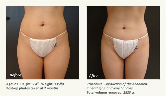 Liposuction Surgery in Dallas & Plano - Patient 34
