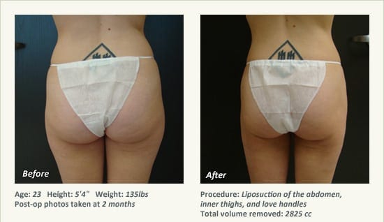 Liposuction Surgery in Dallas & Plano - Patient 35
