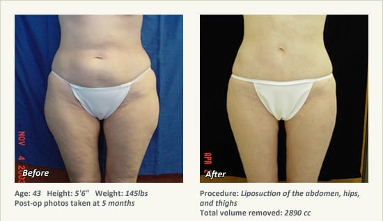 Liposuction Surgery in Dallas & Plano - Patient 36