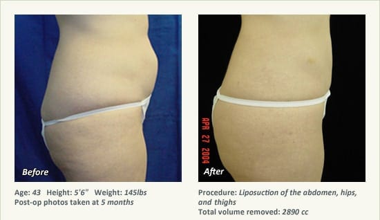 Liposuction Surgery in Dallas & Plano - Patient 37