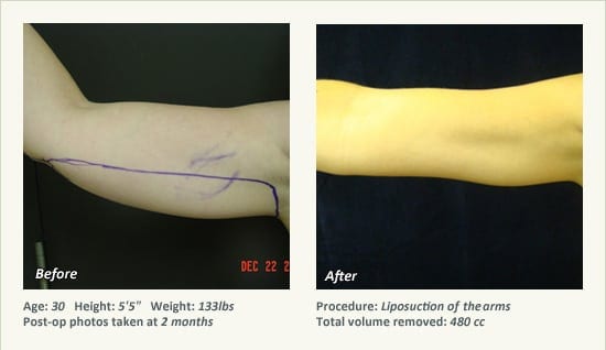 Liposuction Surgery in Dallas & Plano - Patient 38