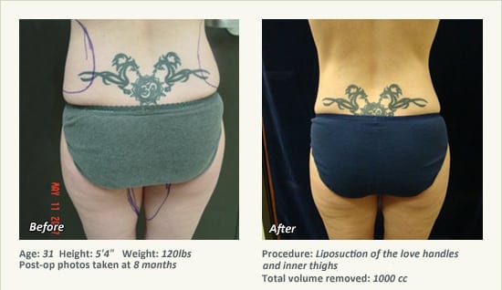 Liposuction Surgery in Dallas & Plano - Patient 40