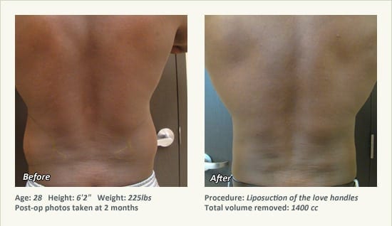 Male Liposuction Surgery - Patient 7