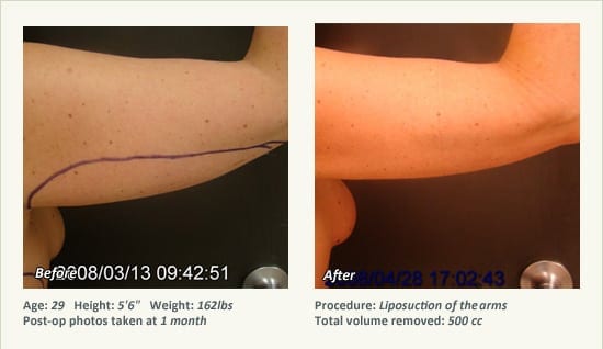 Liposuction Surgery in Dallas & Plano - Patient 41