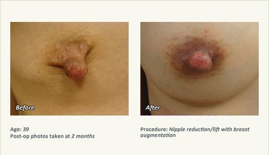 Nipple Procedures (Female) in Plano, TX - Patient 45