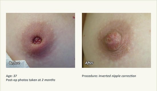 Nipple Procedures (Female) in Plano, TX - Patient 32