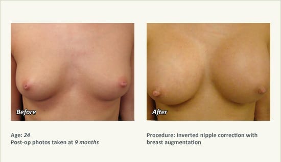 Nipple Procedures (Female) in Plano, TX - Patient 34