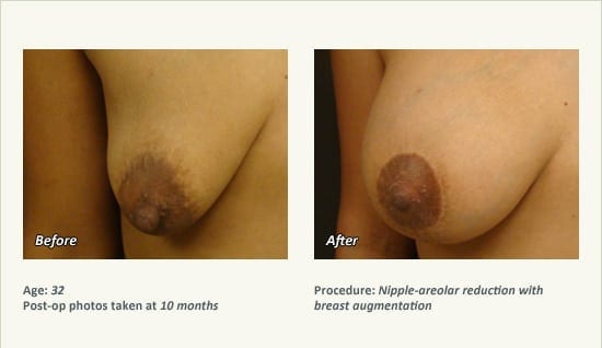 Nipple Procedures (Female) in Plano, TX - Patient 43