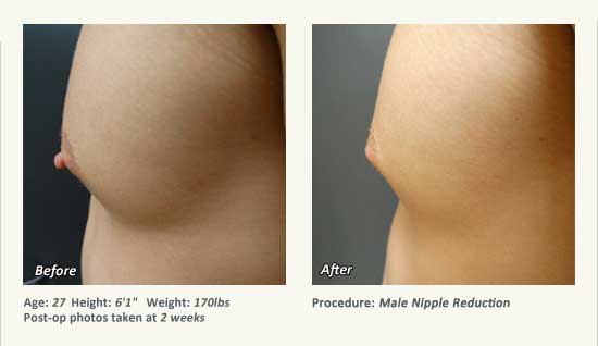 Male Nipple Reduction in Plano, TX - Patient 42