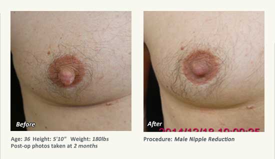 Male Nipple Reduction in Plano, TX - Patient 45