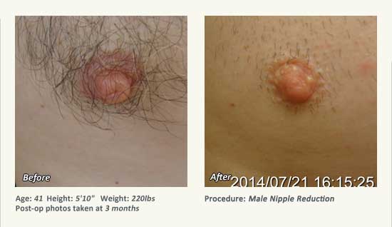 Male Nipple Reduction in Plano, TX - Patient 47
