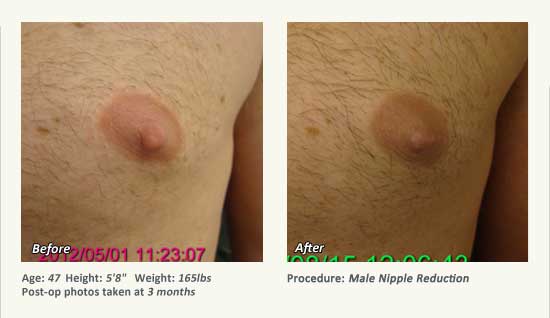 Male Nipple Reduction in Plano, TX - Patient 49