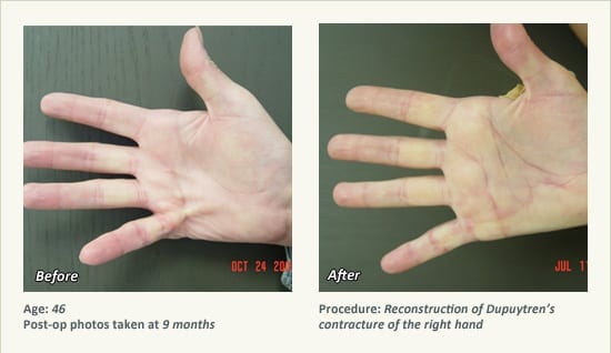 Reconstructive Surgery in Plano, TX - Patient 10
