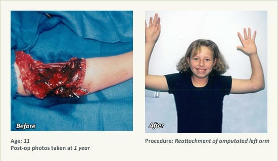 Reconstructive Surgery in Plano, TX - Patient 11
