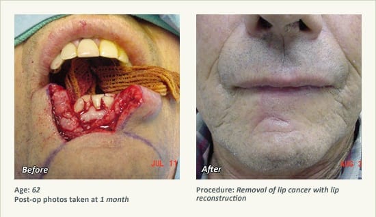 Reconstructive Surgery in Plano, TX - Patient 12