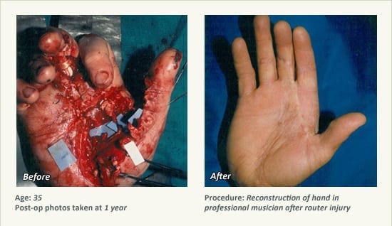 Reconstructive Surgery in Plano, TX - Patient 13