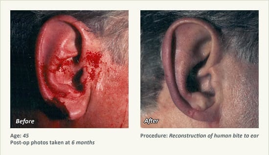 Reconstructive Surgery in Plano, TX - Patient 14