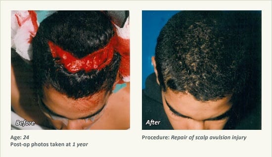 Reconstructive Surgery in Plano, TX - Patient 15