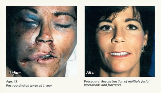 Reconstructive Surgery in Plano, TX - Patient 16
