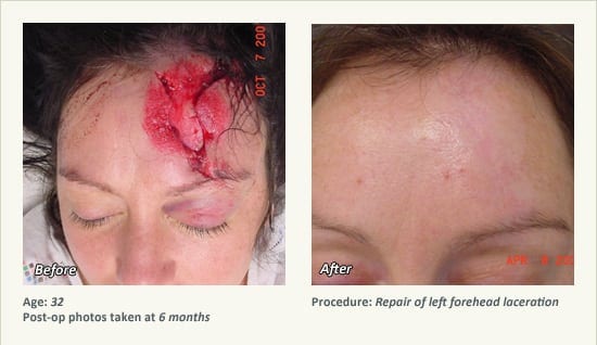 Reconstructive Surgery in Plano, TX - Patient 17