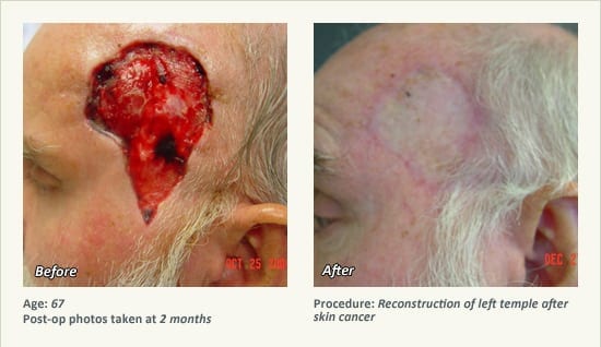 Reconstructive Surgery in Plano, TX - Patient 19