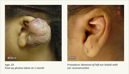 Reconstructive Surgery in Plano, TX - Patient 18
