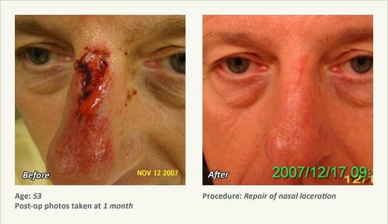 Reconstructive Surgery in Plano, TX - Patient 20