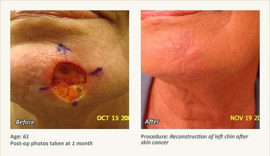 Reconstructive Surgery in Plano, TX - Patient 21