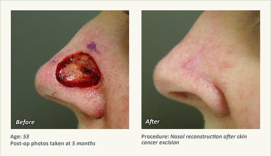 Reconstructive Surgery in Plano, TX - Patient 22