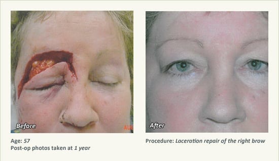 Reconstructive Surgery in Plano, TX - Patient 23
