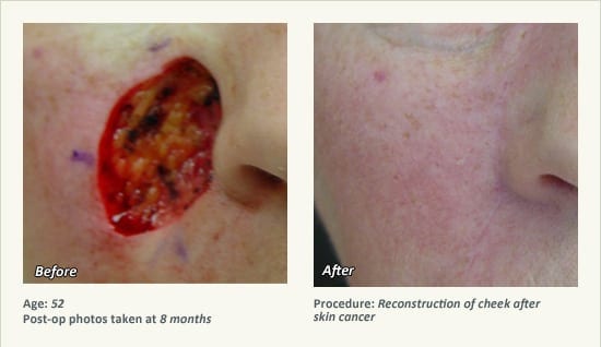 Reconstructive Surgery in Plano, TX - Patient 24