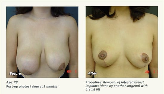 Reconstructive Surgery in Plano, TX - Patient 26