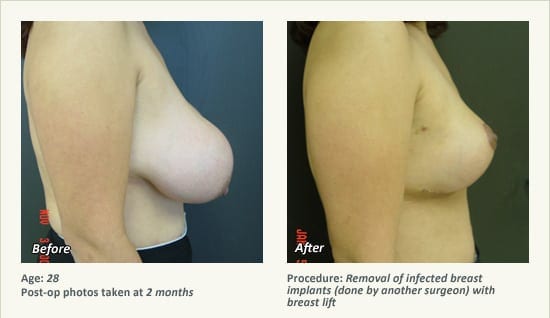 Reconstructive Surgery in Plano, TX - Patient 25