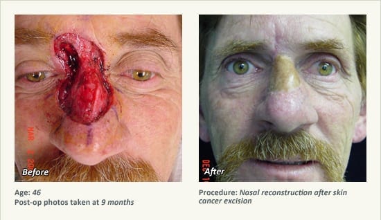 Reconstructive Surgery in Plano, TX - Patient 27