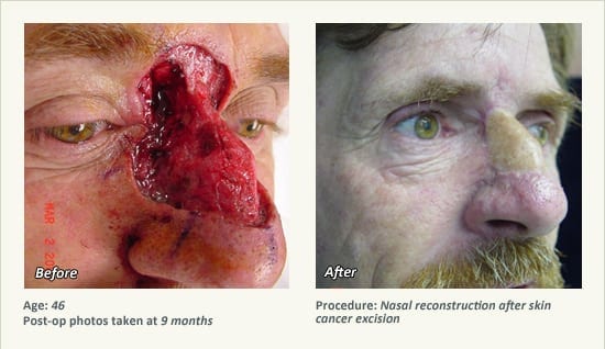 Reconstructive Surgery in Plano, TX - Patient 28