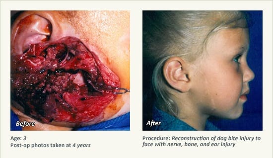 Reconstructive Surgery in Plano, TX - Patient 29