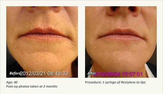 Restylane® & JUVÉDERM® Gel Injectable Fillers In Plano, TX - Patient 27