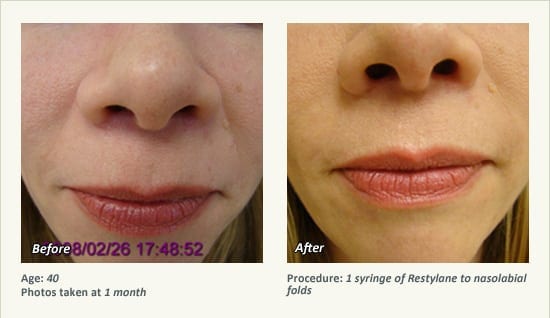 Restylane® & JUVÉDERM® Gel Injectable Fillers In Plano, TX - Patient 40