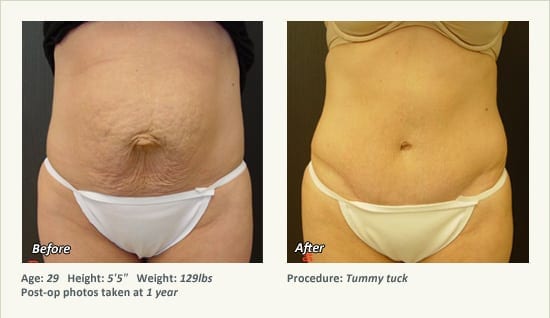 Abdominoplastia en Plano, TX - Patient 13