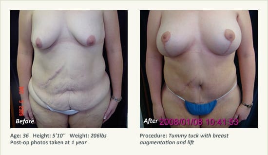Abdominoplastia en Plano, TX - Patient 15