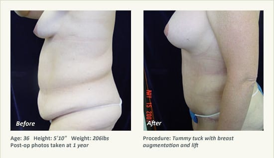 Abdominoplastia en Plano, TX - Patient 16