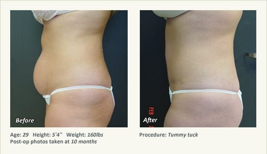 Abdominoplastia en Plano, TX - Patient 20