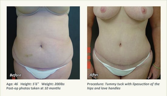 Abdominoplastia en Plano, TX - Patient 21