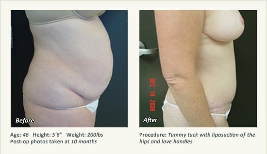 Abdominoplastia en Plano, TX - Patient 22